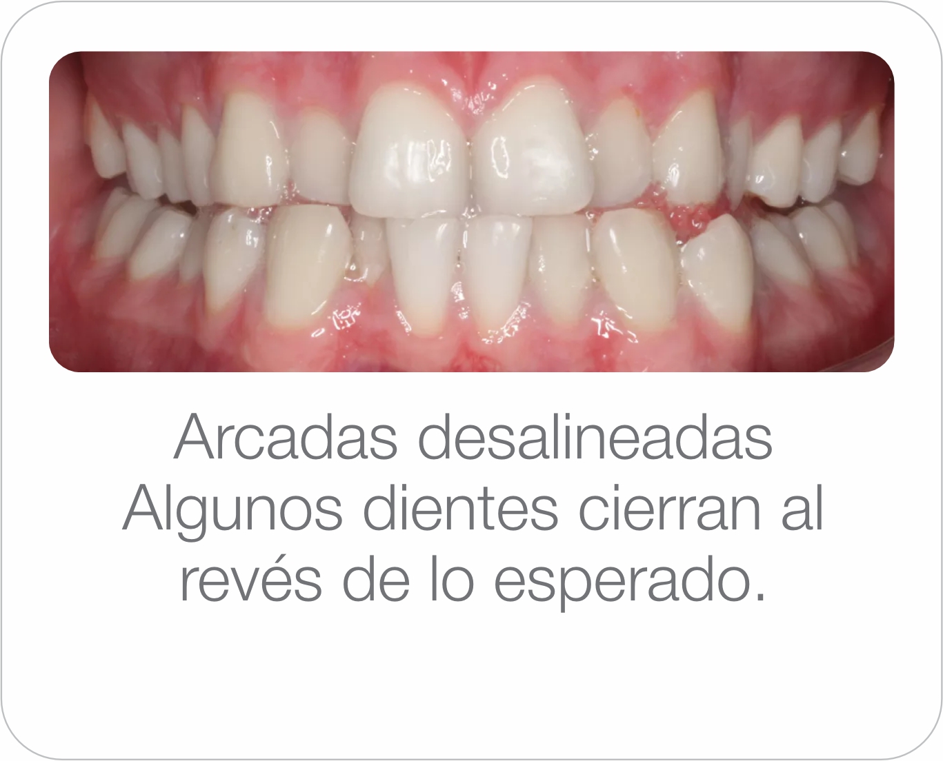 Caso real - Mordida cruzada